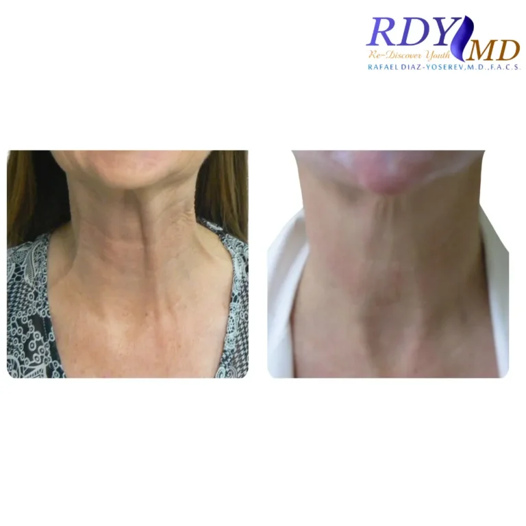 BOTULINUM TOXIN FOR NECK VERTICAL LINES OR PLATYSMA BANDS
