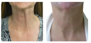 BOTULINUM TOXIN FOR NECK VERTICAL LINES OR PLATYSMA BANDS