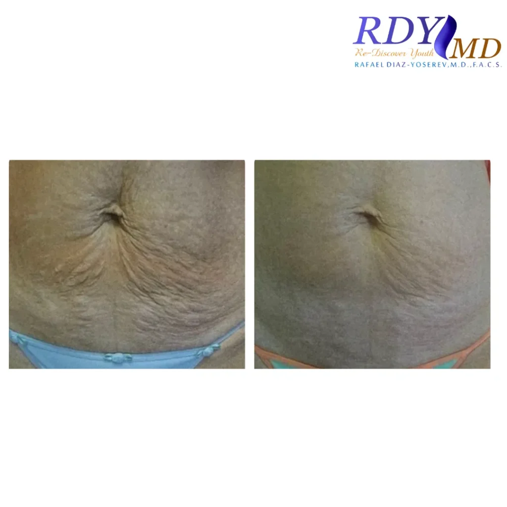 LASER AND RADIOFREQUENCY TREATMENT FOR STRETCH MARKS