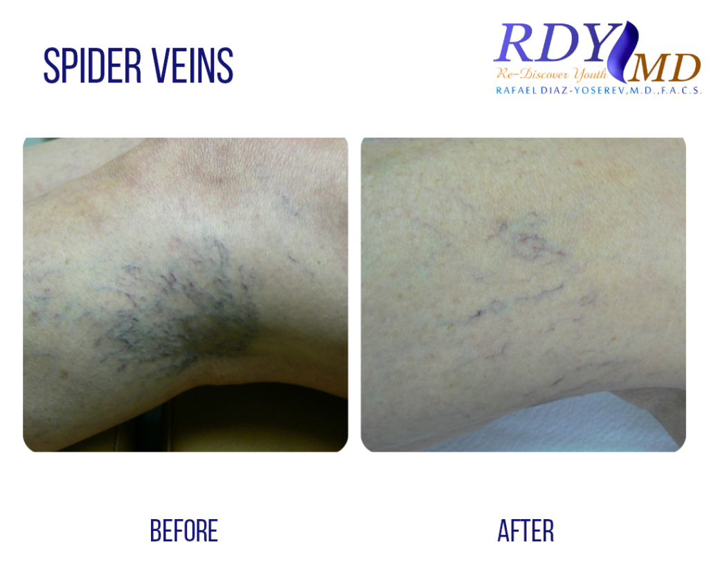 SPIDER VEINS AND VASCULAR LESIONS