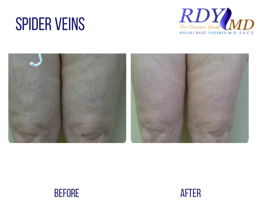 LASER SPIDER VEIN TREATMENT IN LEGS
