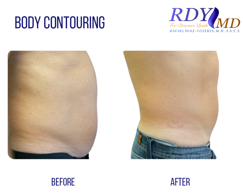 MEN BEFORE AND AFTER PICTURE SMARTLIPO TRIPLEX