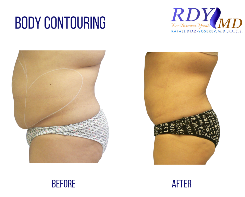 ABDOMEN AND LOVE HANDLES LASER ASSISTED LIPOSUCTION