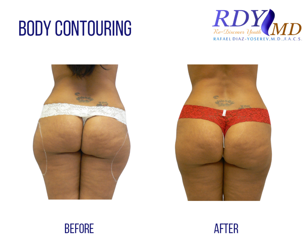 SMART LIPO IN OUTER TIGHTS