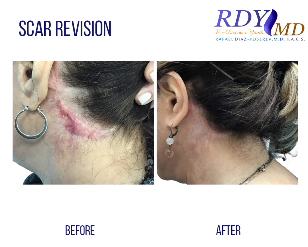 WOMAN WITH BAD SCAR FROM FACELIFT SURGERY TREATED WITH LASERS