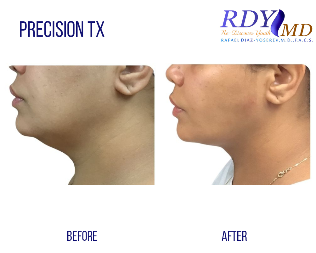PREICISION TX FOR LOWER FACE AND NECK LIFT