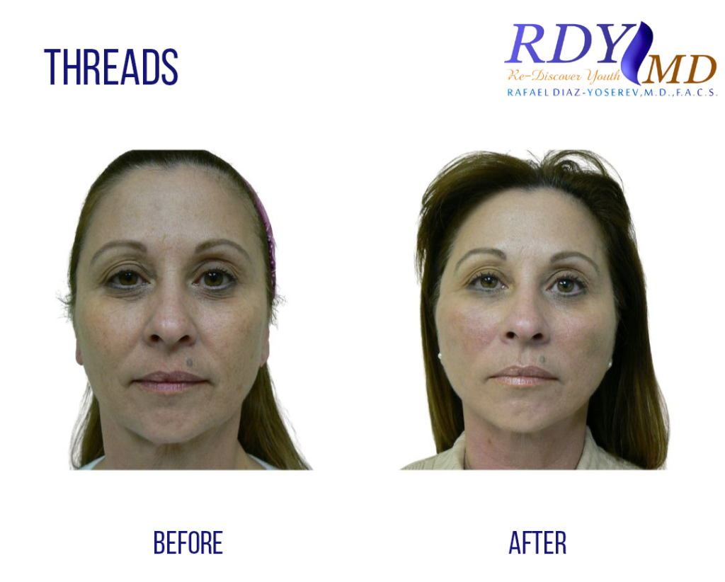 threadlift procedure