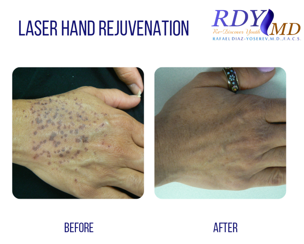 laser HAND REJUVENATION