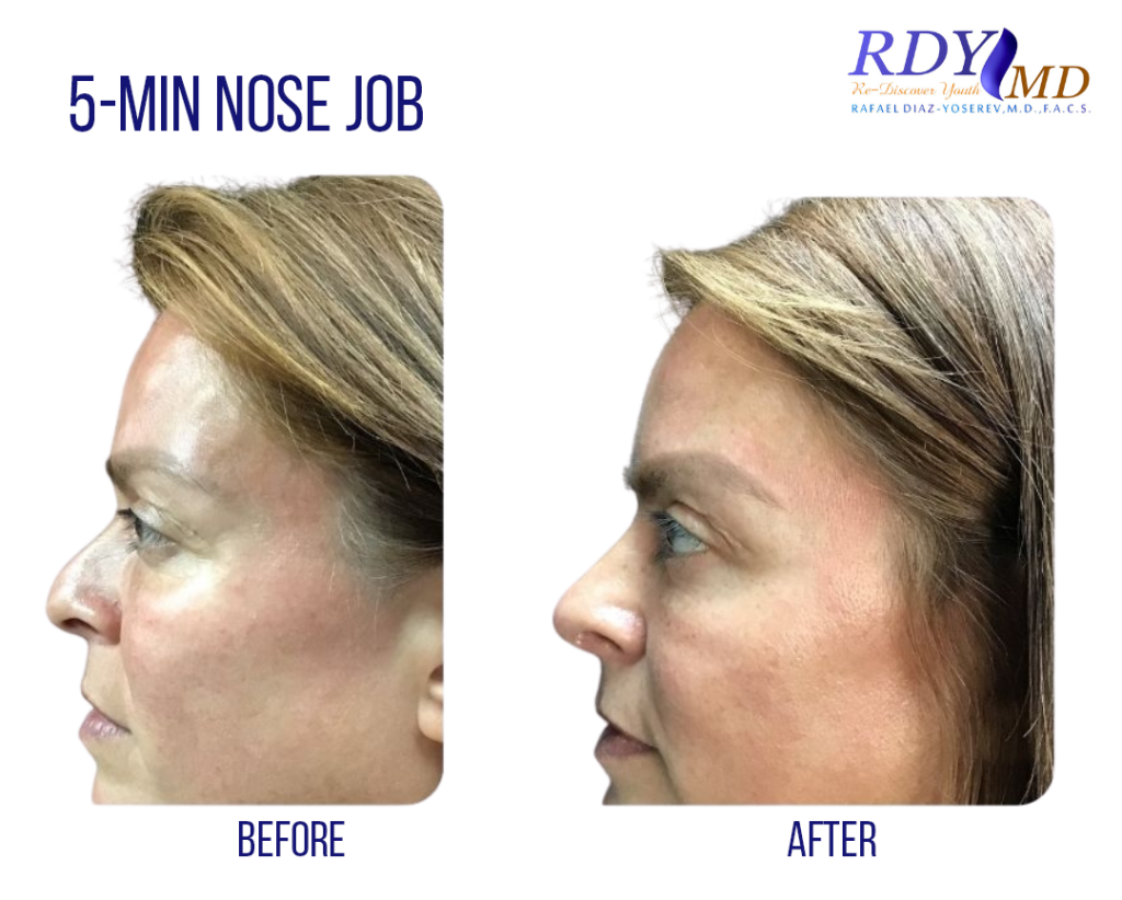 50 yeard old woman with liquid rhinoplasty done in south miami