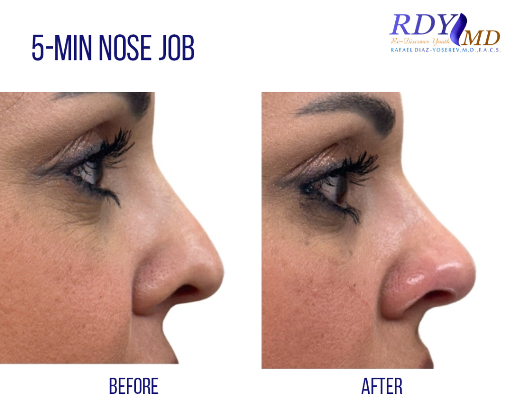 5 min nose job using juvederm in coral gables