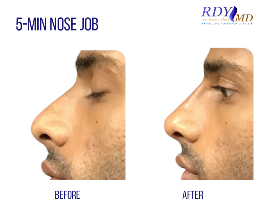 non surgical nose job using filler in miami