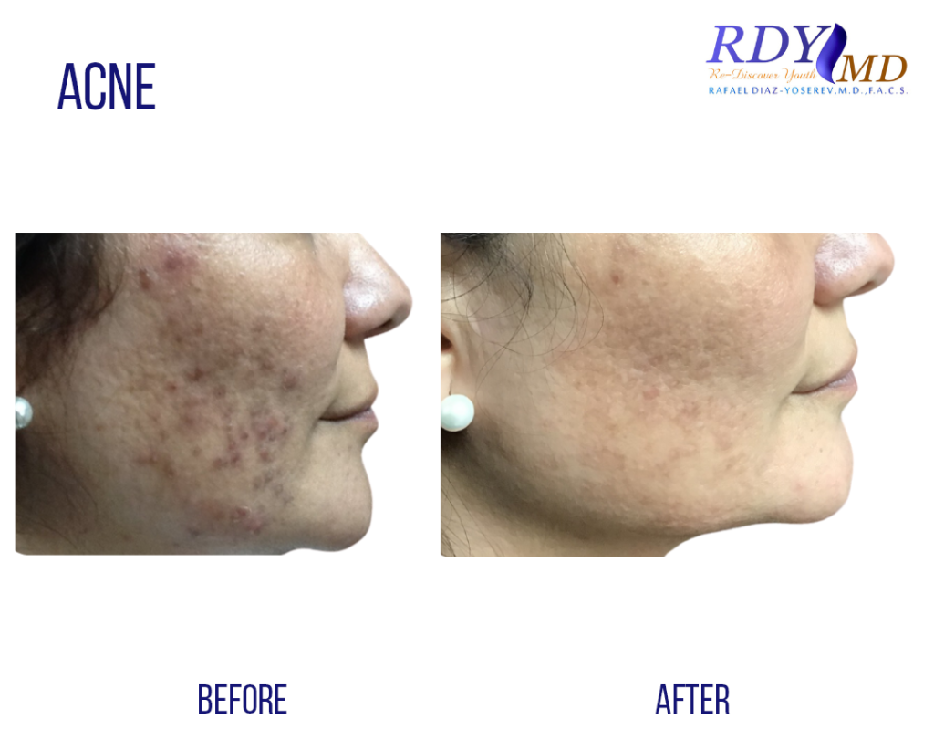 laser acne treatment