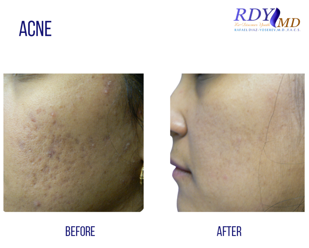 acne marks treated with laser