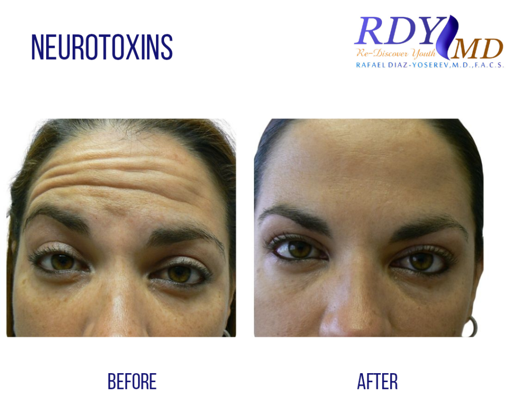 before and after botox treatment for upper face in lady