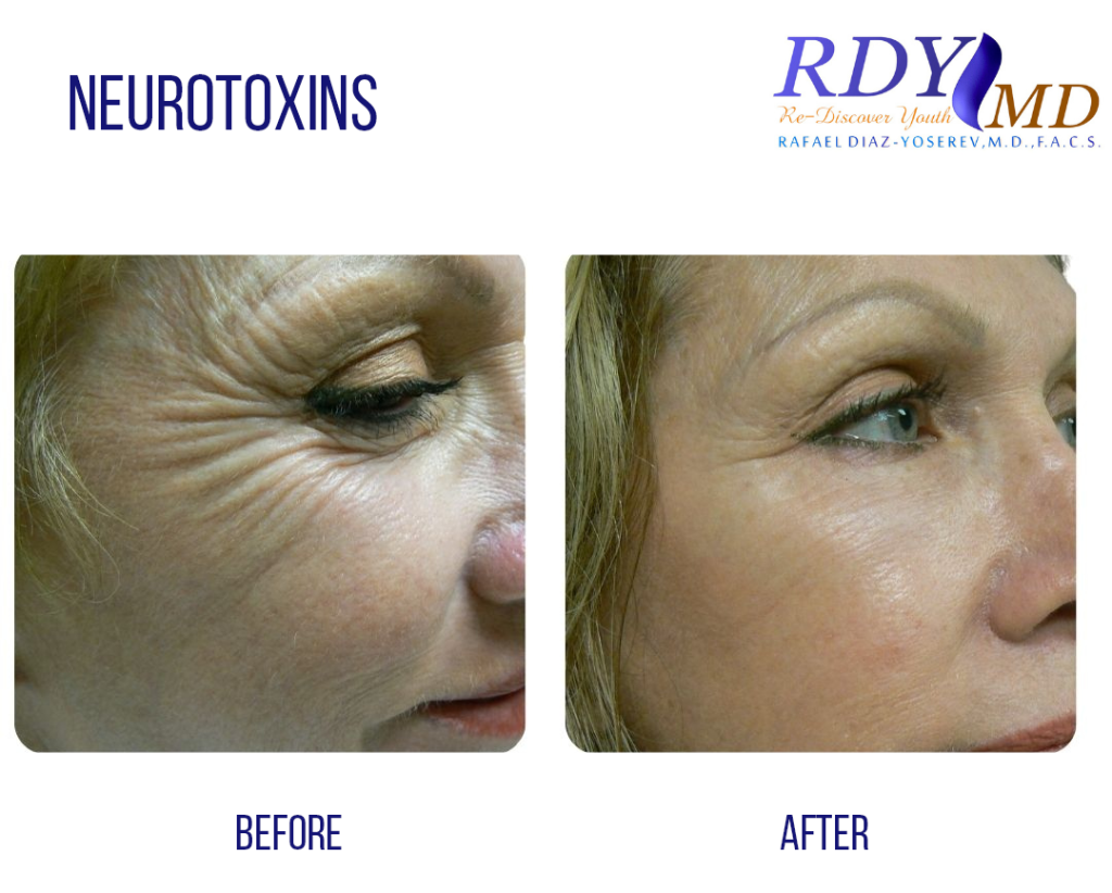 before and after crow's feet xeomin botox injection in woman