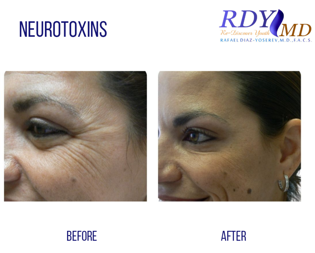 before and after crow's feet xeomin botox injection