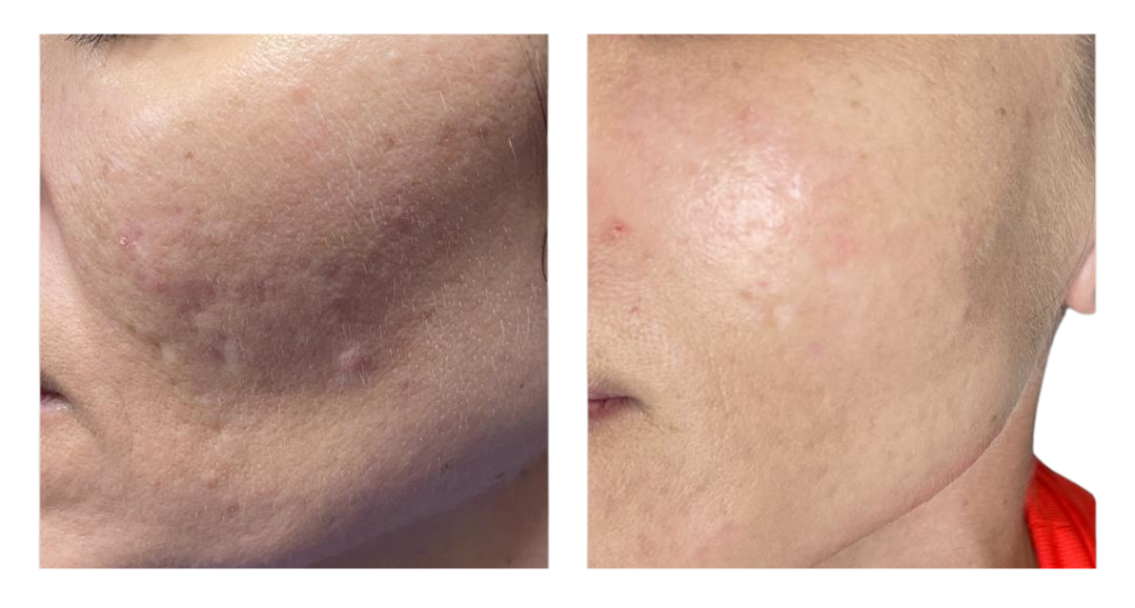 40 YEARS OLD WOMAN WITH ACNE SCARS TREATED WITH DILUTED HYPERDILUTED RADIESSE COLLAGEN BIOSTIMULATOR