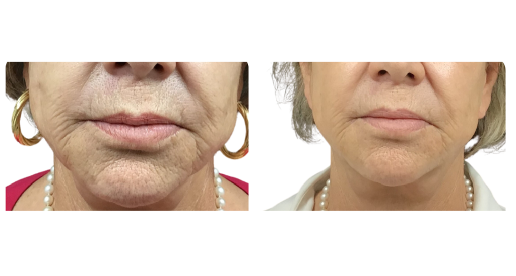 PERIORAL AREA TREATED WITH DILUTED RADIESSE COLLAGEN BIOSTIMULATOR