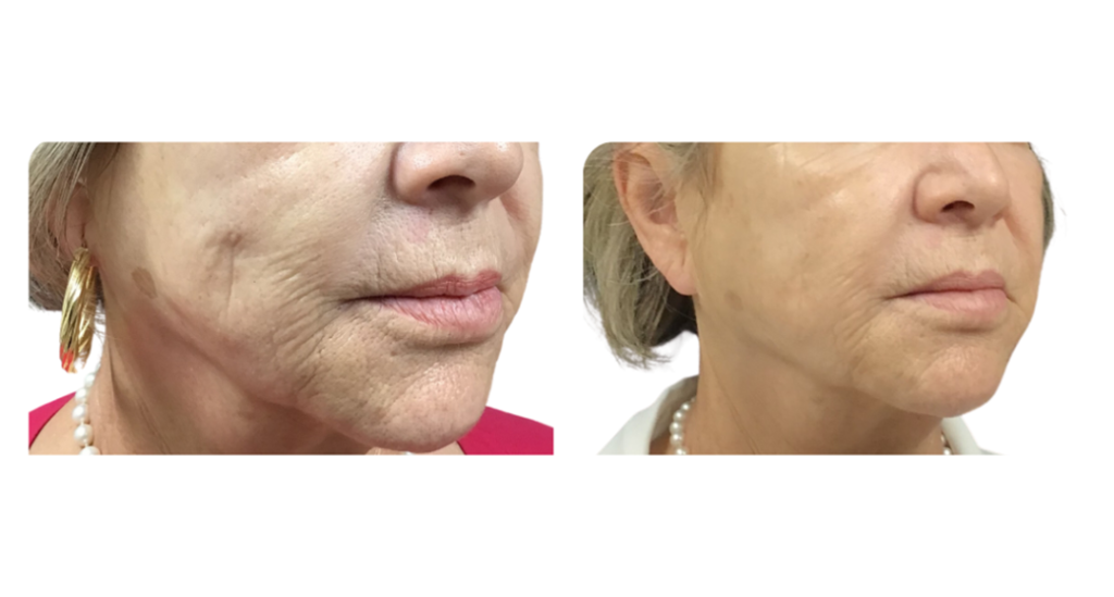 60 YEARS OLD WOMAN WITH CREPEY SKIN AND FINE LINES IN PERIORAL AREA TREATED WITH BIOSTIMULATOR HYPERDILUTED RADIESSE