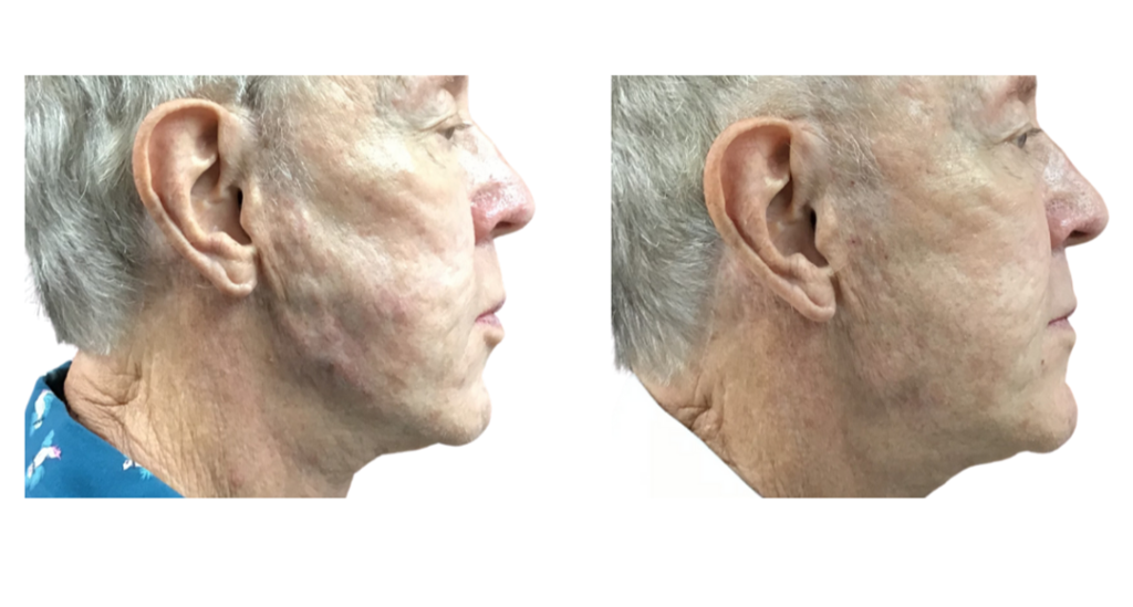 OLD MAN WITH CREPEY SKIN AND LAXITY TREATED WITH DILUTED RADIESSE