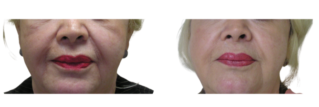 DILUTED HYPERDILUTED RADIESSE COLLAGEN BIOSTIMULATOR TO ADD NATURAL VOLUMEN