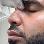 non surgical liquid rhinoplasty 5 min nose job