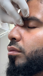 non surgical liquid rhinoplasty 5 min nose job