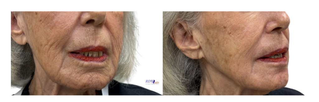 diluted radiesse g f