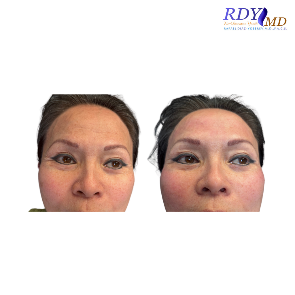 FRACTORA FIRM-FORMA RADIOFREQUENCY coral gables