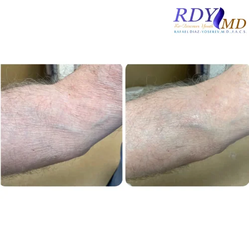 revivify, aquagold, microchanneling, microneedling