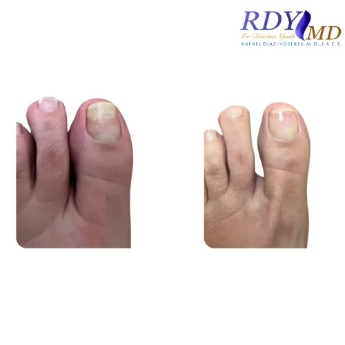 LASER TOENAIL FUNGUS TREATMENT