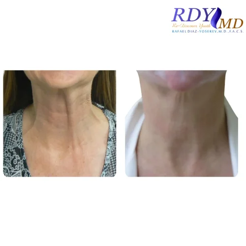 BOTULINUM TOXIN FOR NECK VERTICAL LINES OR PLATYSMA BANDS